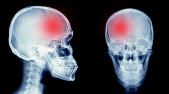 Traumatic Brain / Head Injuries